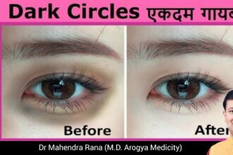 Dark Circle | आंखों के काले घेरे गायब।। कारण और समाधान | Dr.Mahendra Rana 20 NxvqqplUOr4 HD