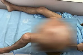 Big Breaking News: 27 वर्षीय युवक के पैर से निकाला गया 35 किलो का कैंसरग्रस्त ट्यूमर, एम्स ऋषिकेश की बड़ी उपलब्धि-Newsnetra 16 rishikesh tumer 1750775639108