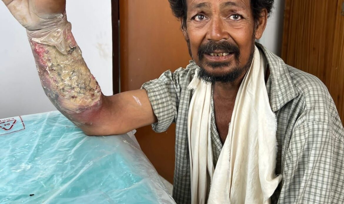 दून अस्पताल से लाइलाज रेफर हुए व्यथित राजू का, बर्न स्पेशलिस्ट हेल्पिंग हैंड्स यहां ऑपरेशन हुआ संपन्न;-Newsnetra 4 img 20250720 wa00102282769022081284376